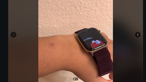 Apple Watch S12被曝佩戴后皮肤发红